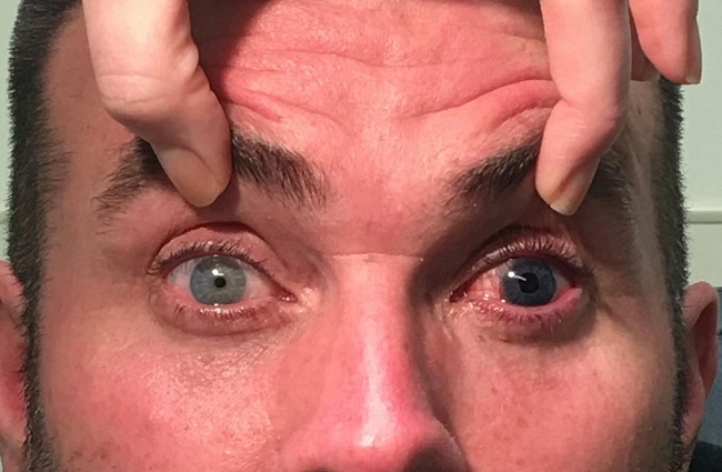 Robert's eye after recovering from his two surgeries